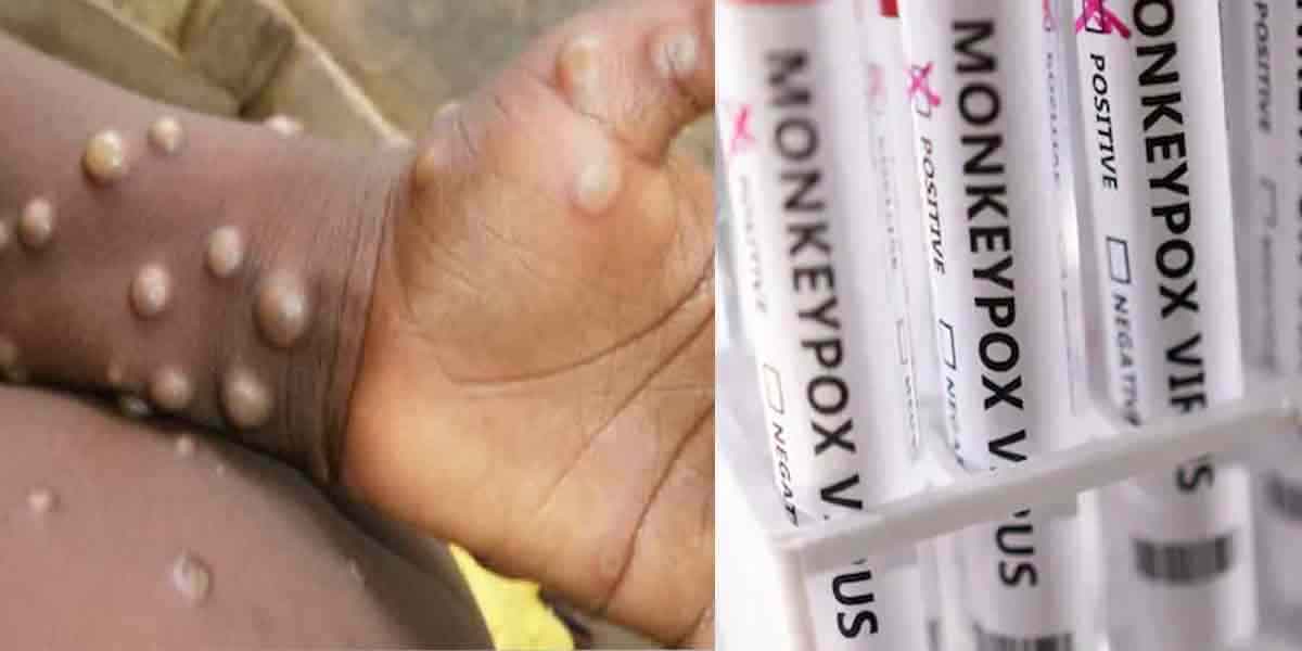 The World Health Organization is considering changing the name of monkey measles!