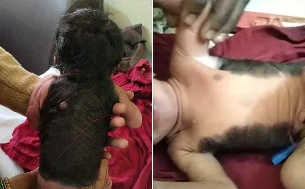 A baby born with hair all over his back