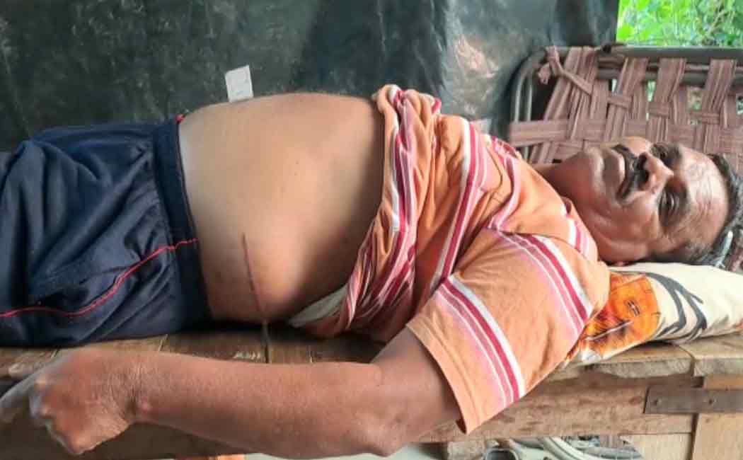 A person who went to the hospital for kidney stones; It's a pity that the kidney itself was stolen