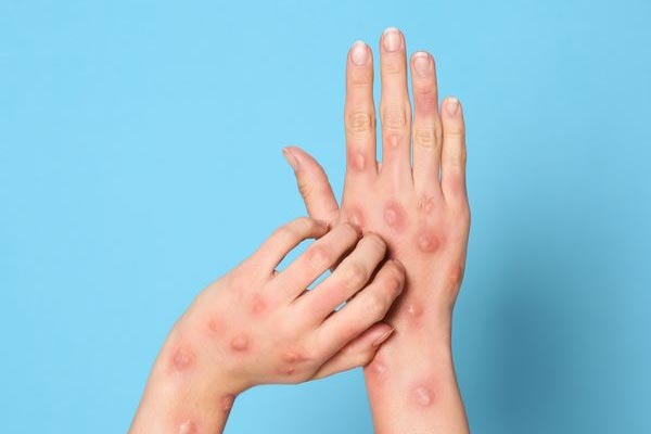 Trichy Collector's information on The youth admitted to the hospital does not have MPOX