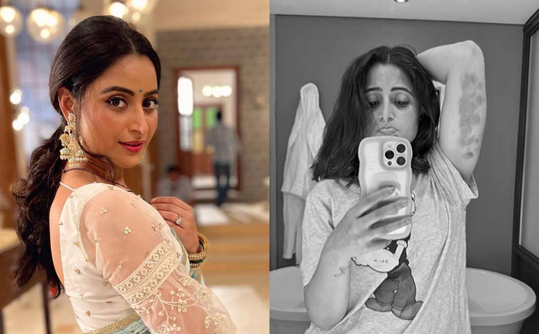 Aishwarya Sharma injures arm on sets