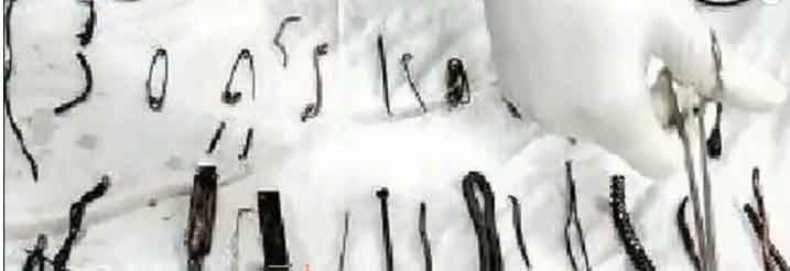 One and a half kilogram iron fibers stomach