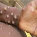 The World Health Organization is considering changing the name of monkey pox